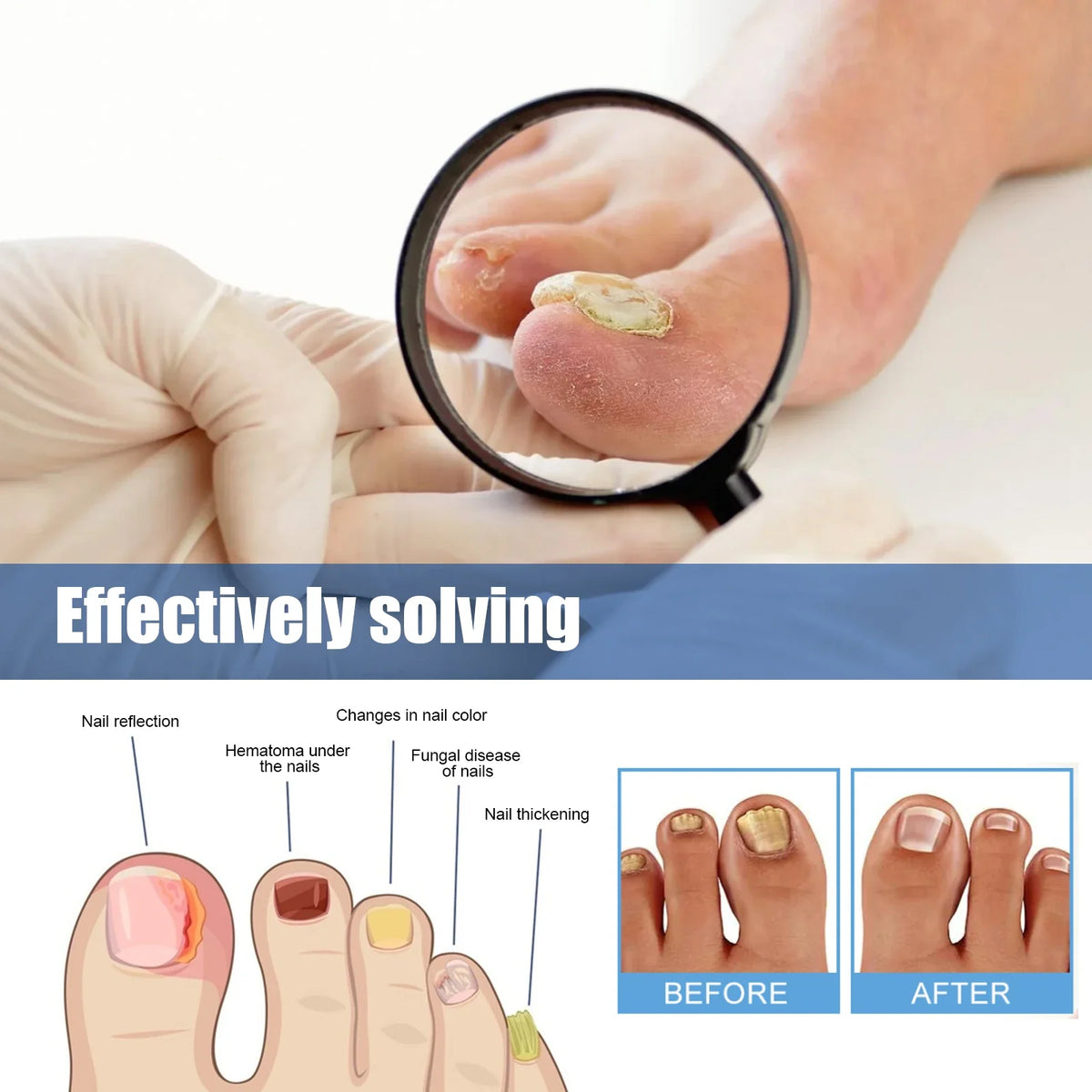 Fungus Nail Repair Patches