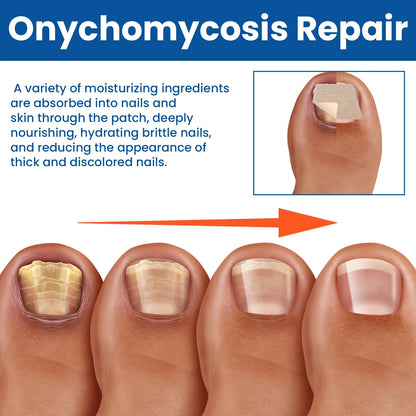 Fungus Nail Repair Patches